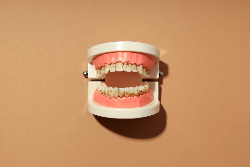 Apa Penyebab Karang Gigi dan Cara Menghilangkannya