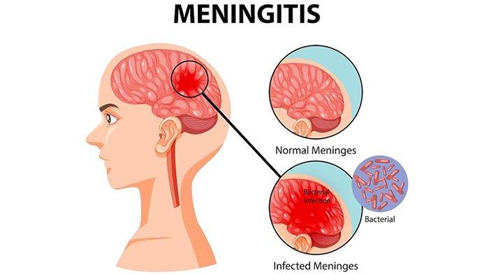 Apa itu meningitis streptococcus suis?
